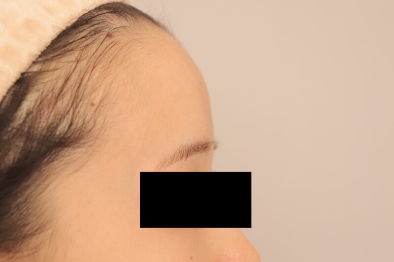 おでここめかみの脂肪注入のモニター様半年後♡