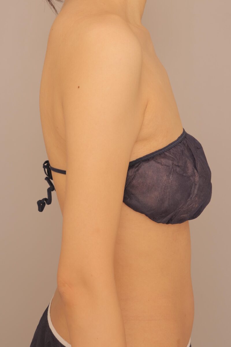 スラッとした華奢な二の腕に♡二の腕肩の脂肪吸引半年後