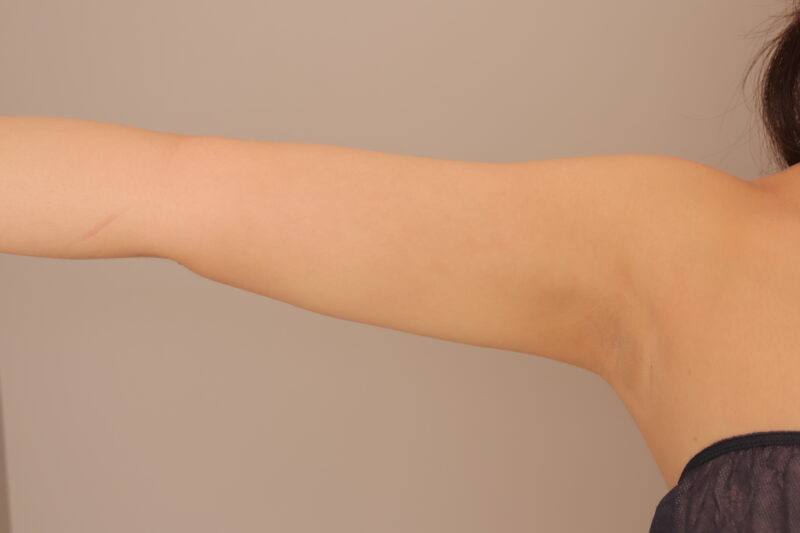 二の腕、肩の脂肪吸引でしっかりラインを変える！モニター様3ヶ月後