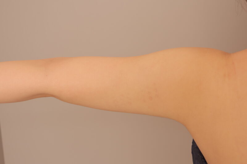 二の腕肩のモニター様3ヶ月後♡