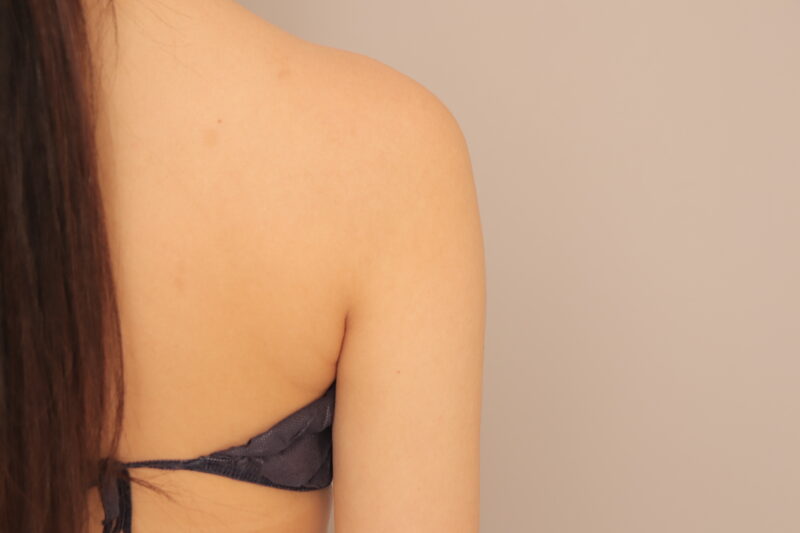 二の腕、肩の脂肪吸引半年後♡