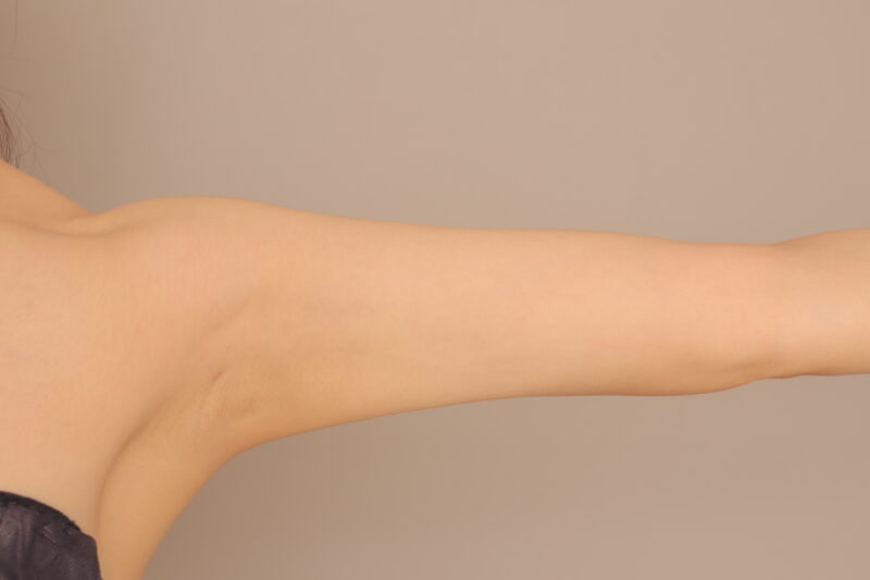 痩せ型のモニター様の二の腕肩の脂肪吸引からの豊胸♡