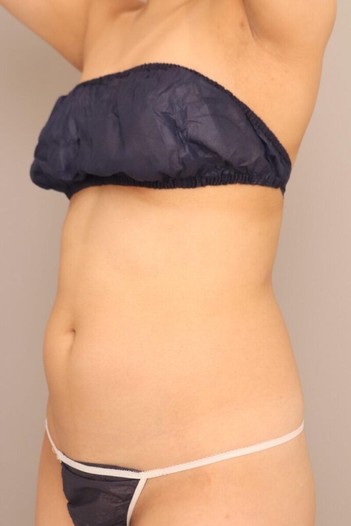 お腹の脂肪吸引 半年経過