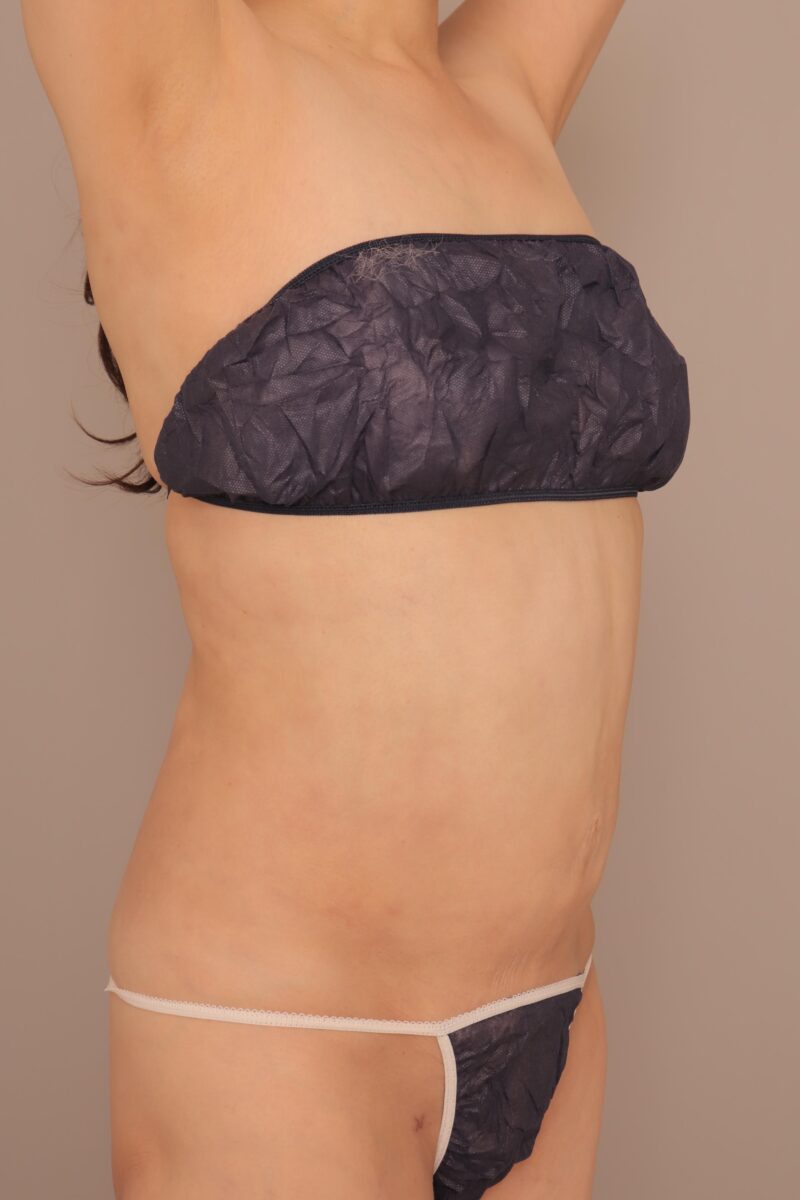 58歳お腹腰の脂肪吸引1ヶ月後♡