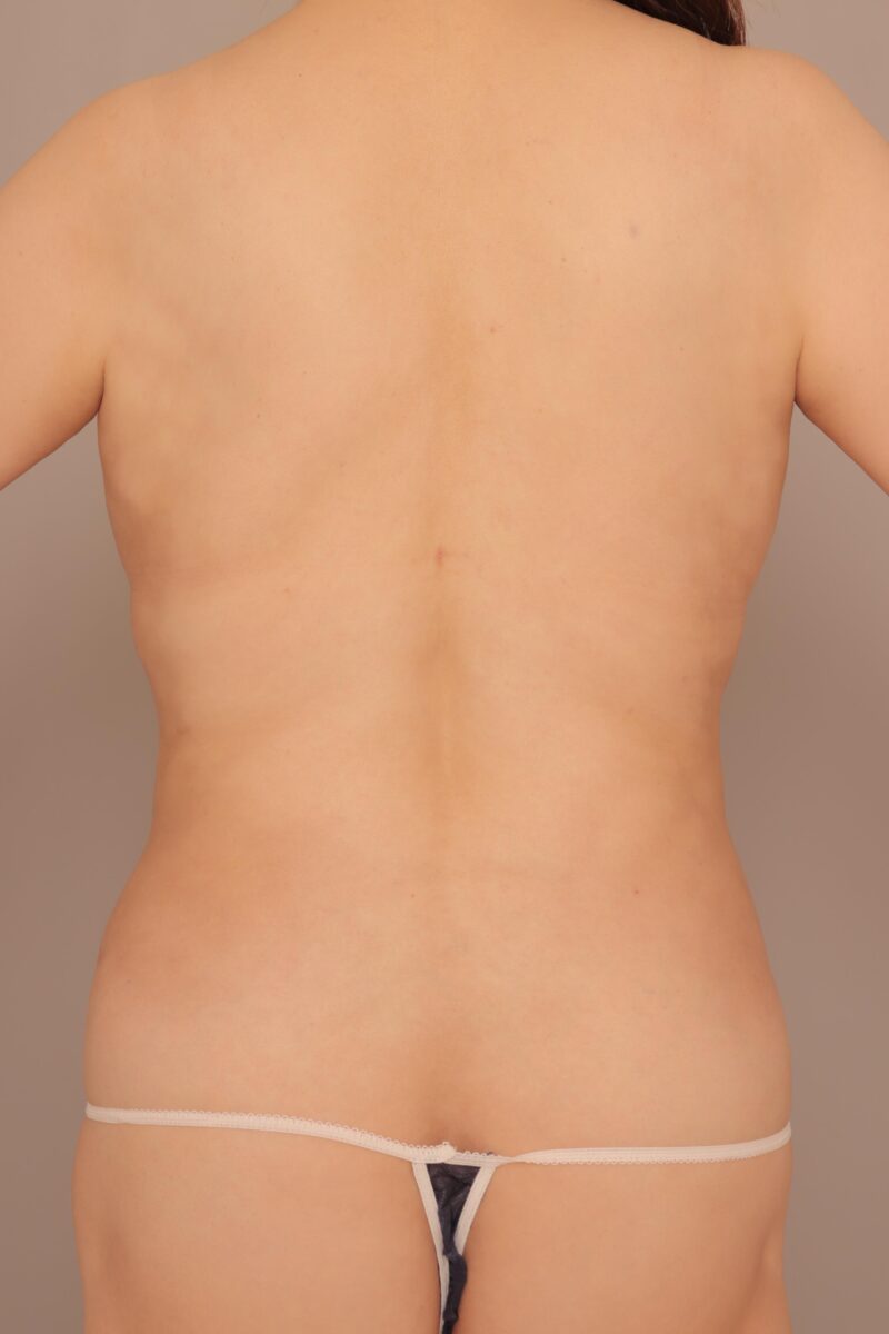 年齢が出る背中のシルエットを変えよう!58歳モニター様背中の脂肪吸引2ヶ月後♡