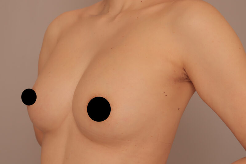 脂肪のお引越しは女子の夢♡47歳コンデンスリッチ豊胸のモニター様半年後