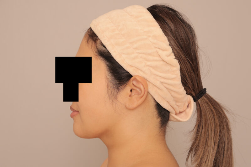 頬顎脂肪吸引でフェイスラインくっきり!!モニター様半年後♡