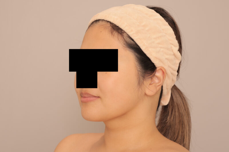 頬顎脂肪吸引のモニター様半年後♡