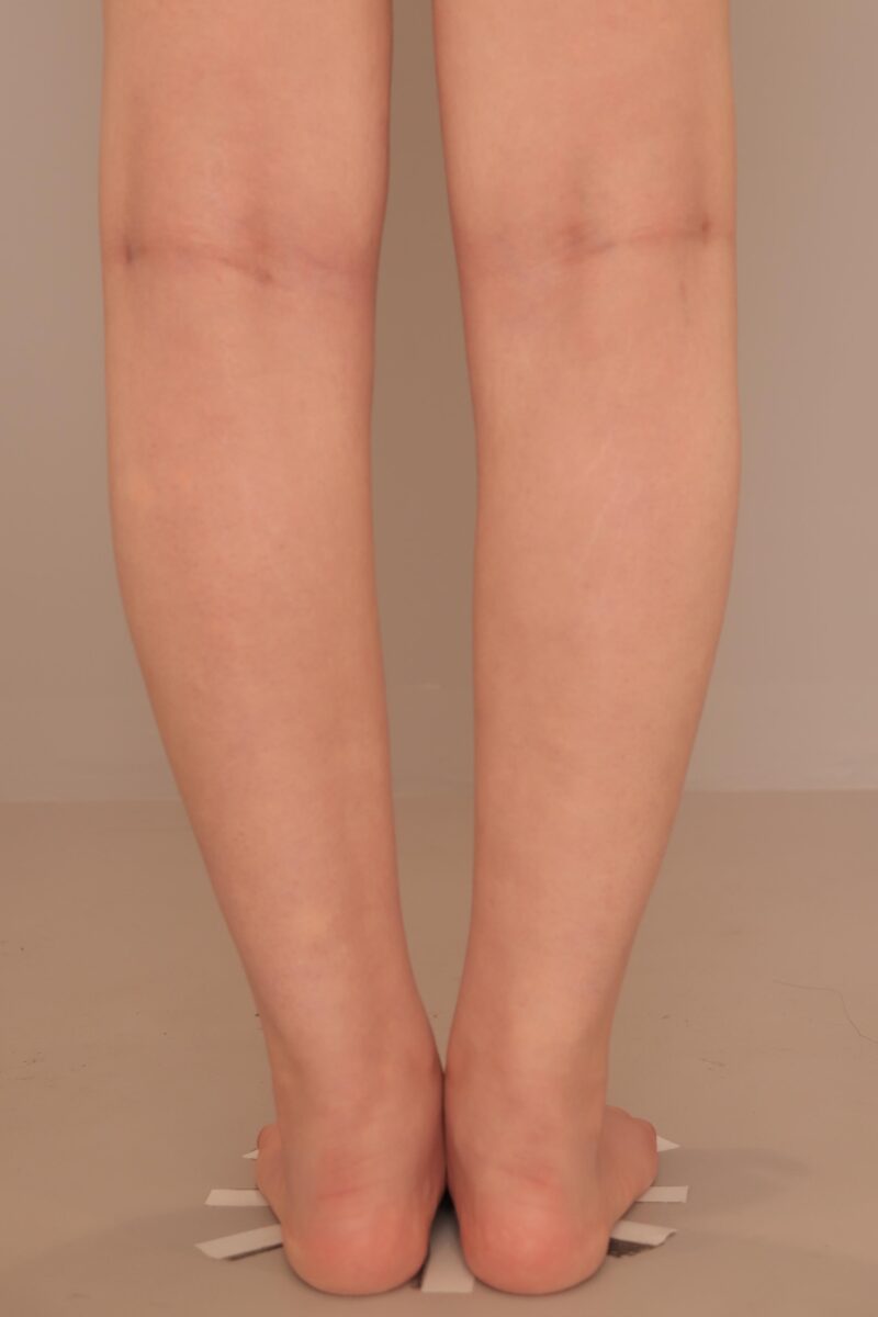 ふくらはぎ足首の脂肪吸引&ボトックスのモニター様半年後♡