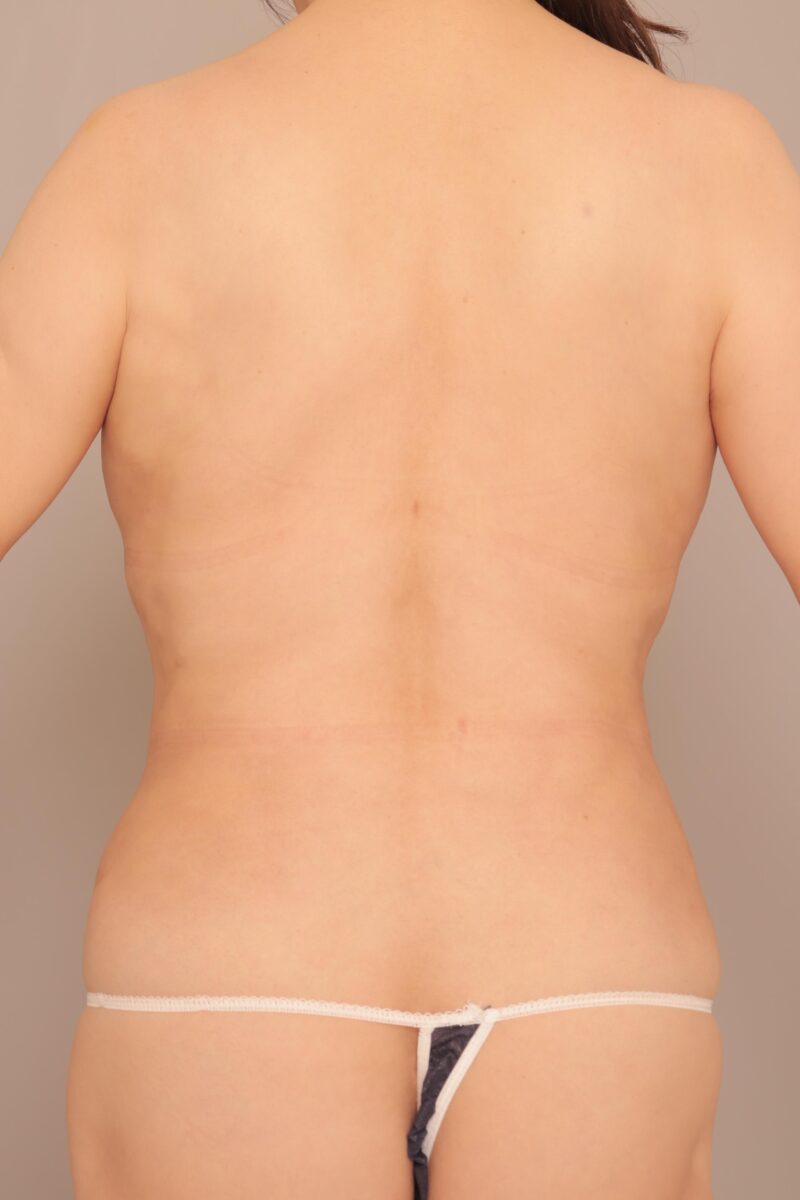 58歳の背中を若返らせる!背中の脂肪吸引3ヶ月後♪