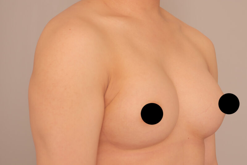 男性豊胸のモニター様3年半後の変化!脂肪注入豊胸でも激変可能です!