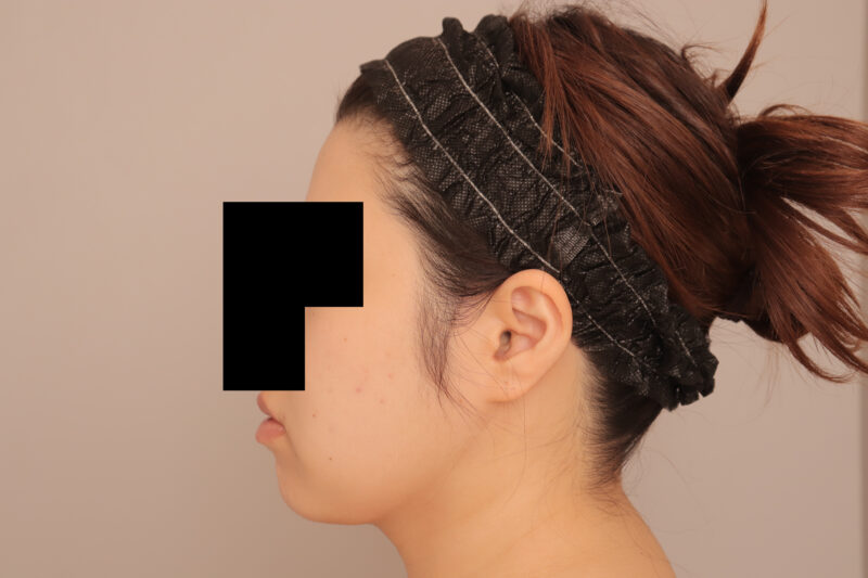 花嫁様のフェイスラインをスッキリ!モニター様3ヶ月後