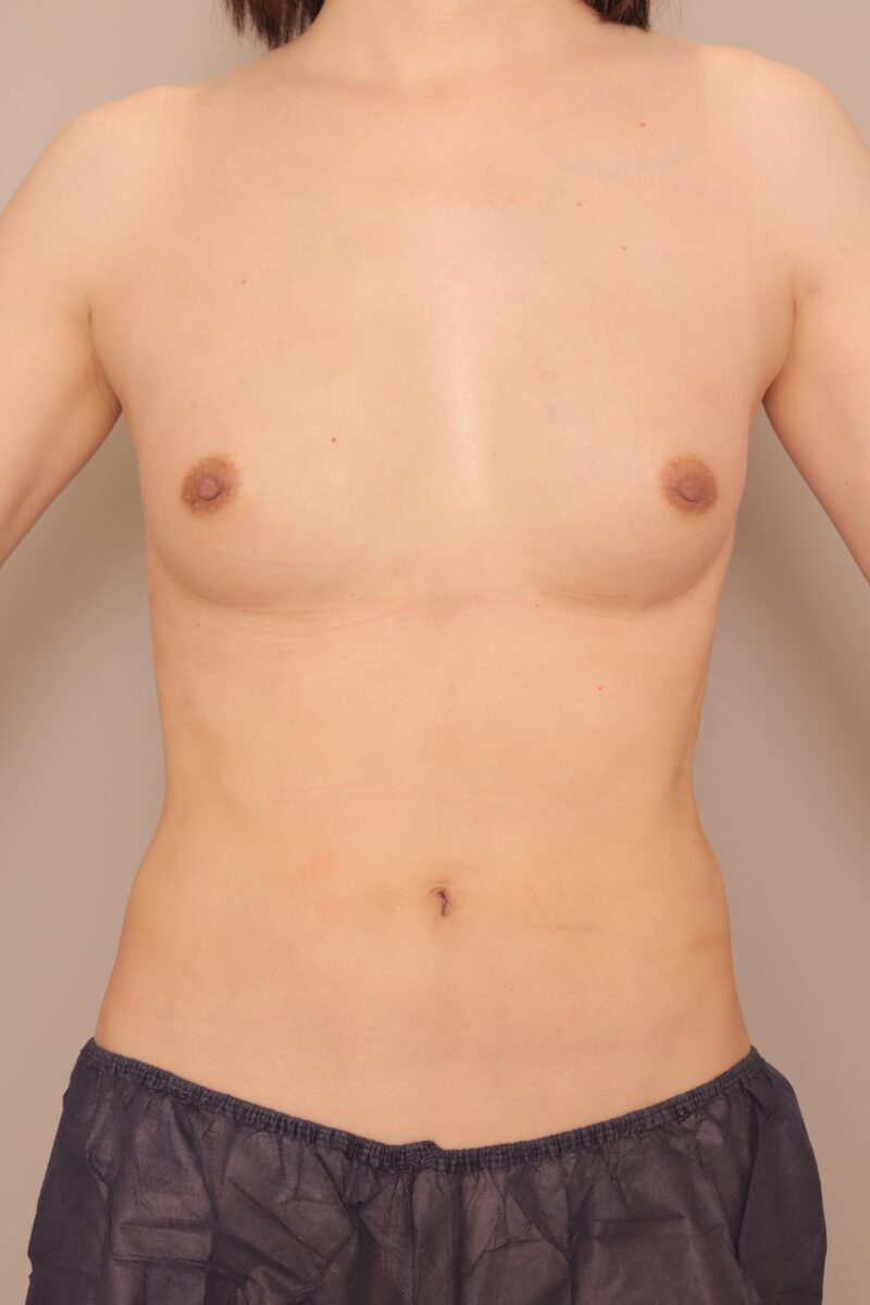 39歳男性豊胸(ホルモン治療あり)のモニター様1ヶ月後の変化♡