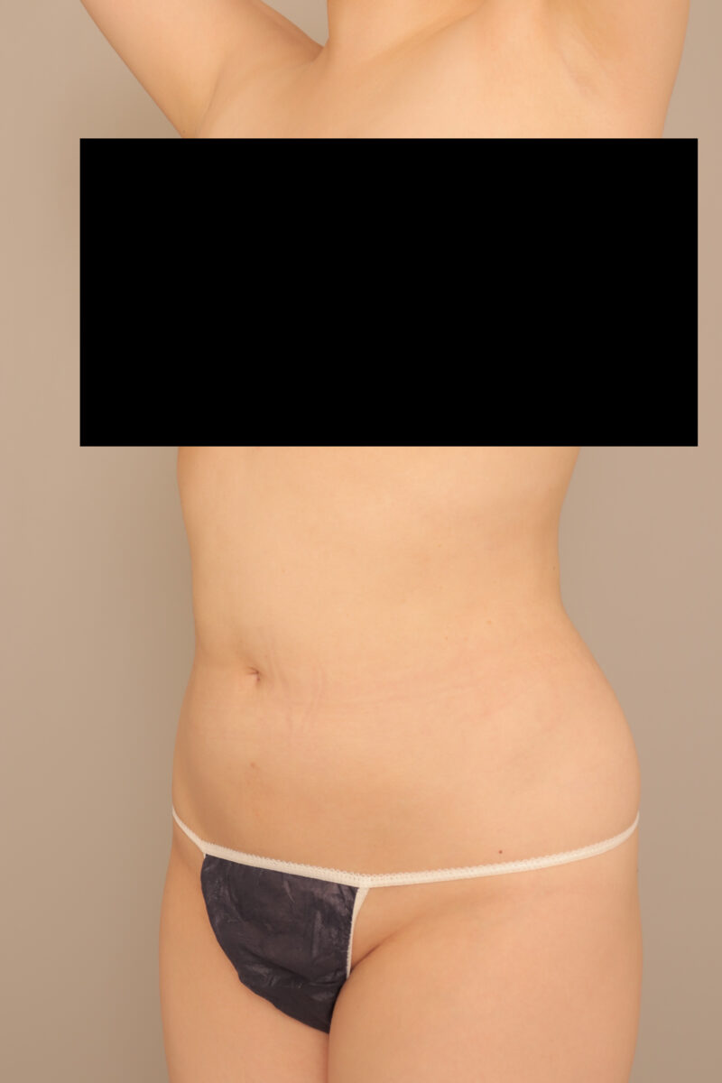 みんなで目指そう峰不二子♡34歳モニター様半年後♪