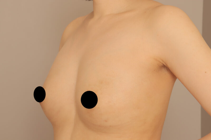 30kgダイエットで体重を落としたらバストがしぼんでしまった!コンデンスリッチ豊胸で元通りに!モニター様3ヶ月後♪