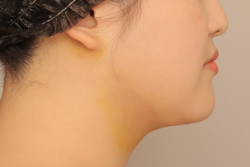アゴ下の脂肪吸引1週間後♪