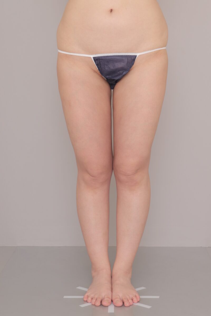 脂肪吸引した？なんて言わせない自然な細さ １ヶ月経過～34歳, 162cm, 60.4kg～★