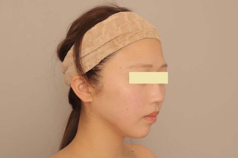 ★脂肪吸引のみでここまで変化でます！