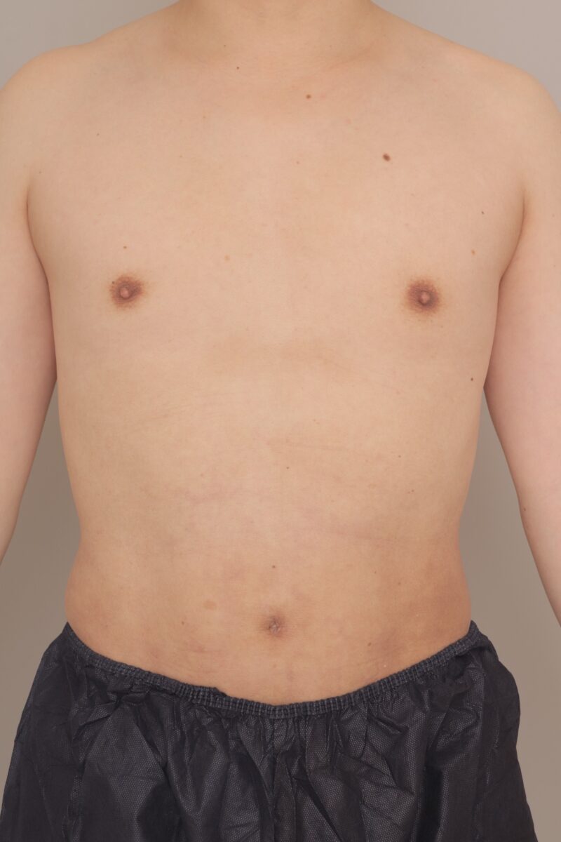 【男性】お腹ポッコリ解消し逆三角形体型に！ ３か月経過～40歳, 170cm, 68.4kg～
