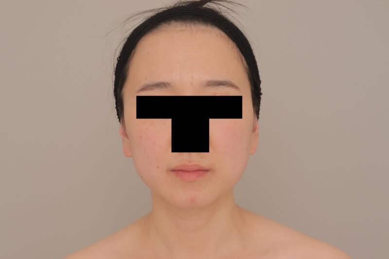 もたつきがすっきりしてフェイスラインを整える ３か月経過～34歳, 156cm, 49.8kg～