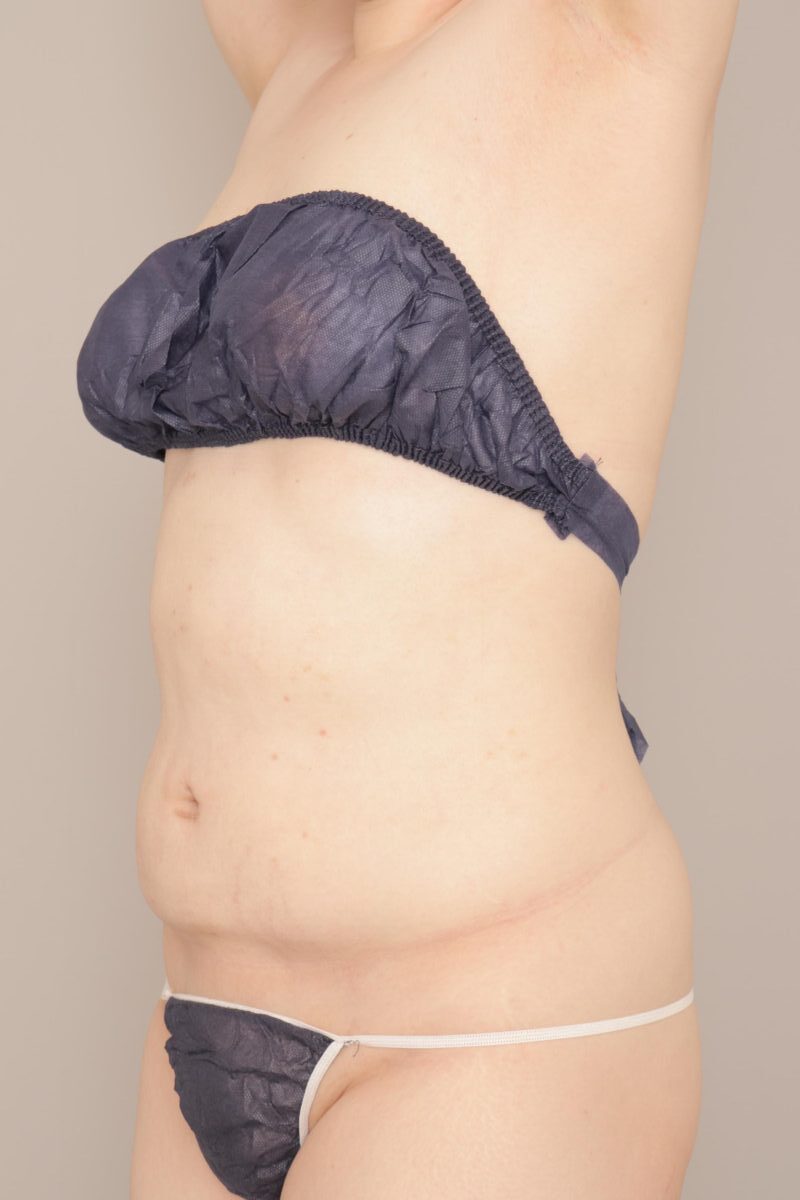 母の日常　お腹大量吸引をしたら…皮膚はどうなる？？①