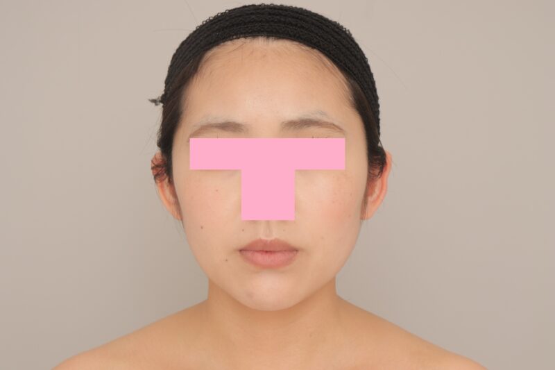 頬顎下脂肪吸引でみんなに褒められるフェイスラインに♪　モニター様の6か月経過をご紹介♪　24歳 157cm 48kg