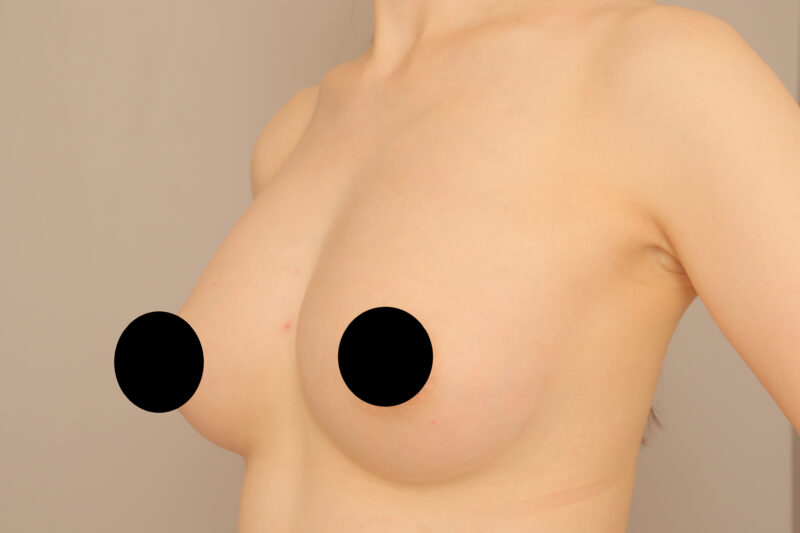 ベイザー脂肪吸引（1年後経過：35）の術後写真