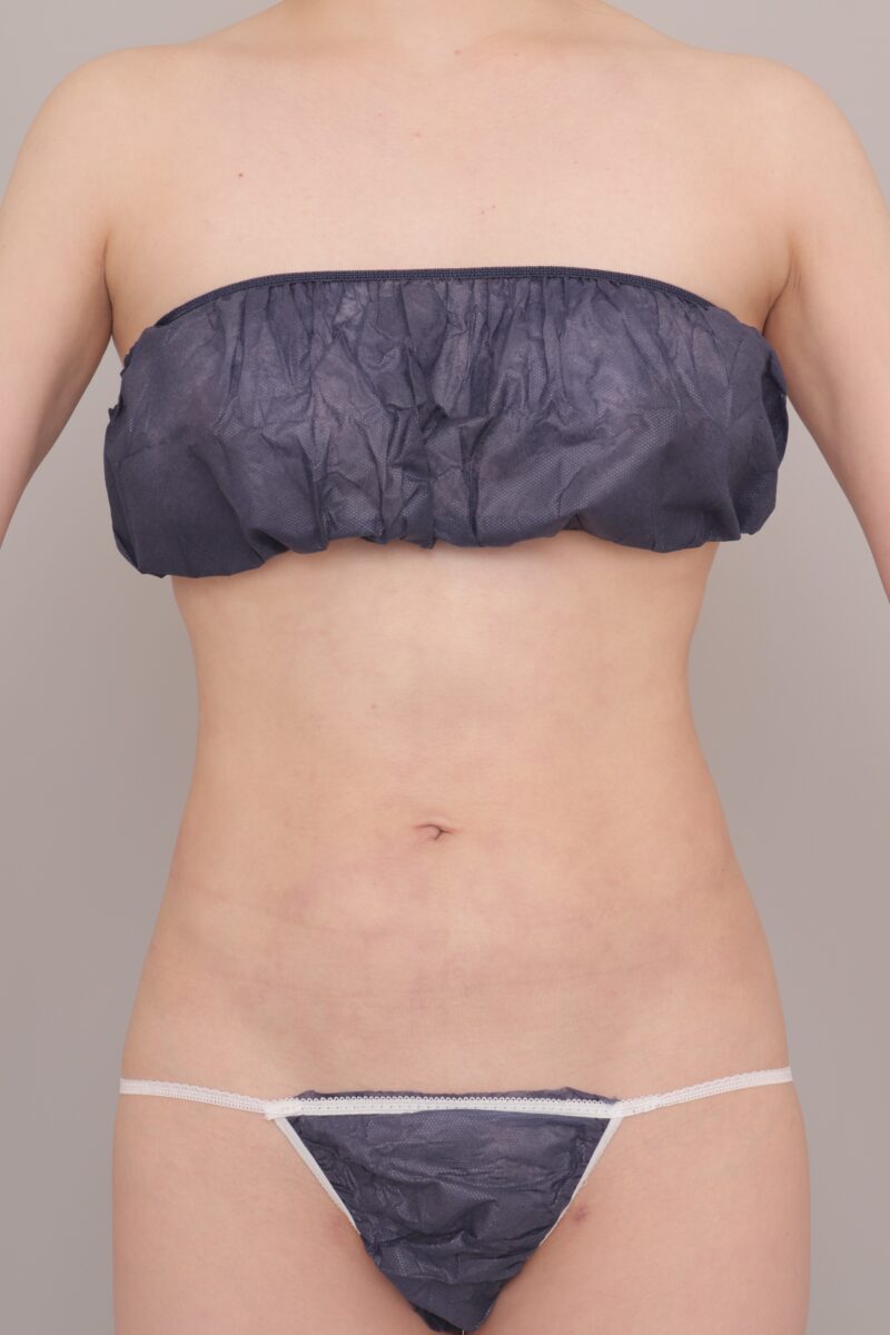 ボディにメリハリがつくとラインが綺麗に！ ６ヶ月経過～30歳, 160cm, 49.2kg～★