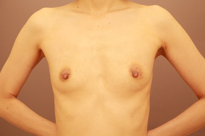 コンデンスリッチ豊胸+乳頭縮小　３か月経過