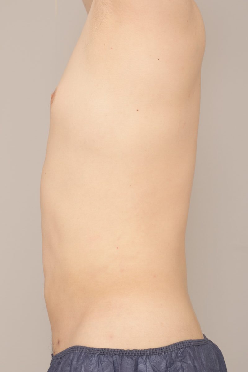 メンズの腹腰吸引♪　モニター様の6か月経過をご紹介♪　44歳 173cm 77kg