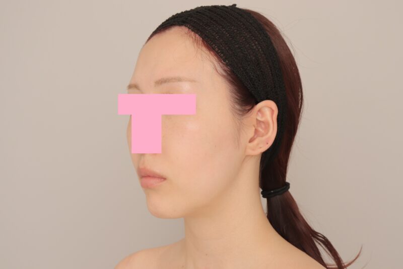 ベイザー脂肪吸引（6か月経過：29）の術前写真