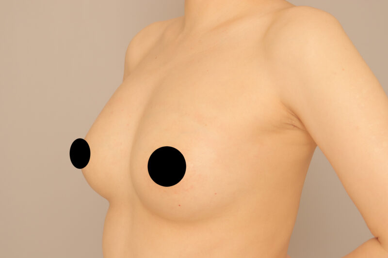 めざせ産前よりきれい!コンデンスリッチ豊胸でますますふっくら美バストに♡モニター様4ヶ月後