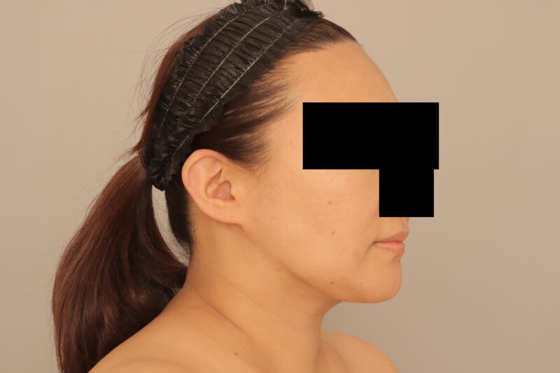 44歳ほほ顎脂肪吸引で人生を変える!!モニター様3ヶ月後