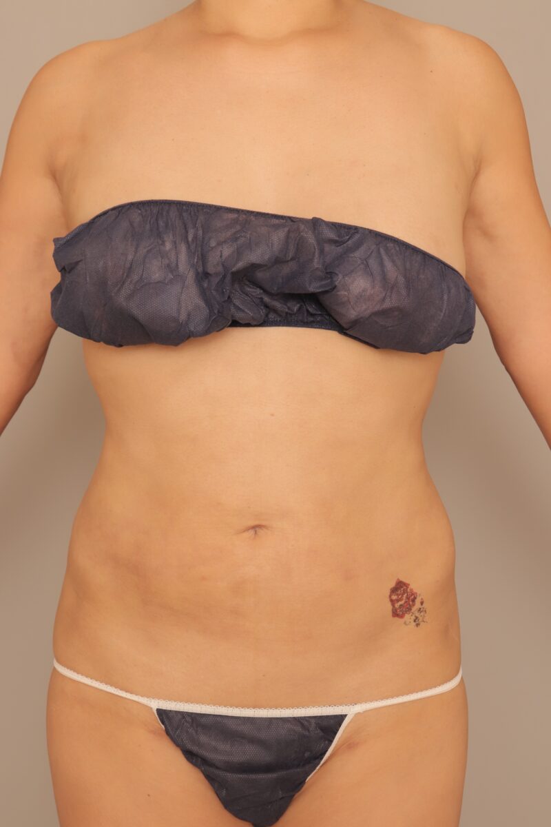 15歳年下の男性にボディが美しすぎると褒められナンパされた!50代お腹全体胸下腰の脂肪吸引モニター様半年後♡