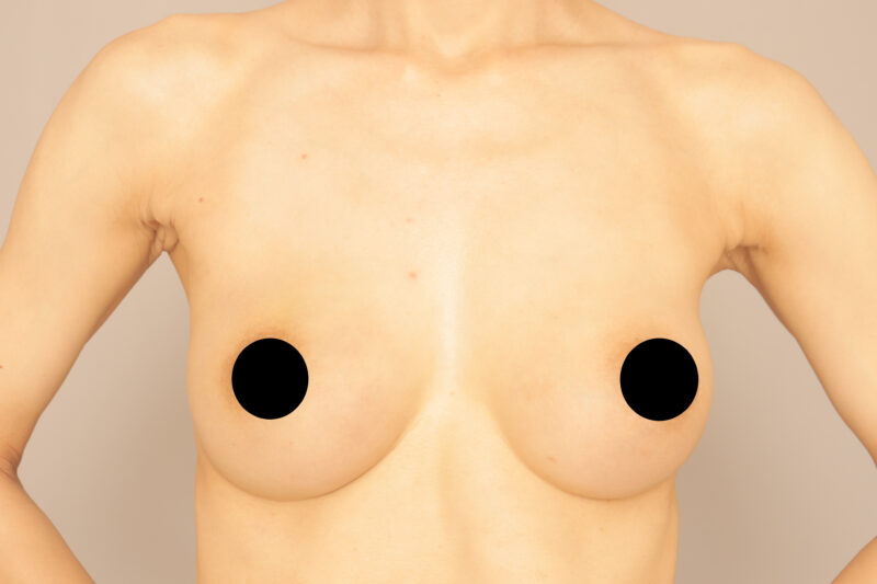 生食バックを抜去&コンデンスリッチ豊胸で自然なバストに♡モニター様1ヶ月後!