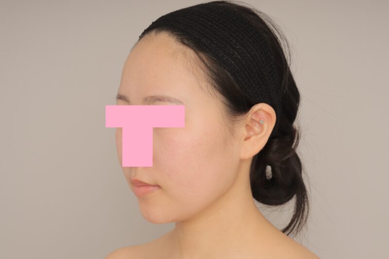 ベイザー脂肪吸引（6か月経過：23）の術後写真