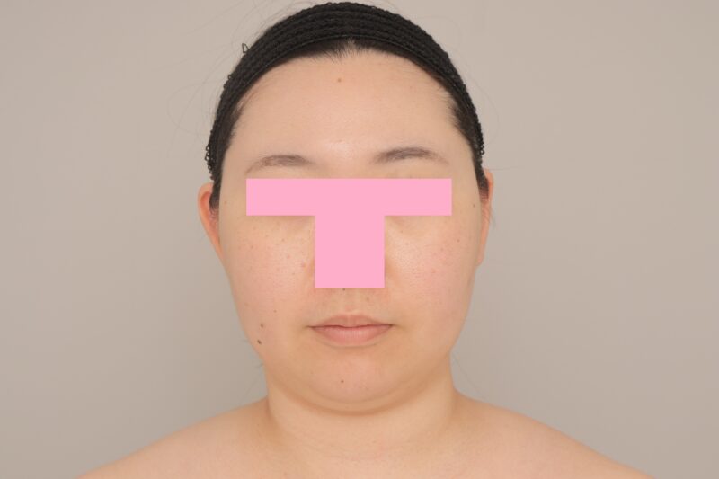 ベイザー脂肪吸引（6か月経過：28）の術前写真