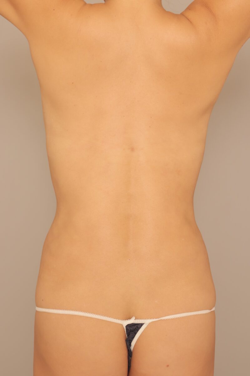 50代美女サーファーの背中を変える!肩甲骨上下腰の脂肪吸引半年後♡