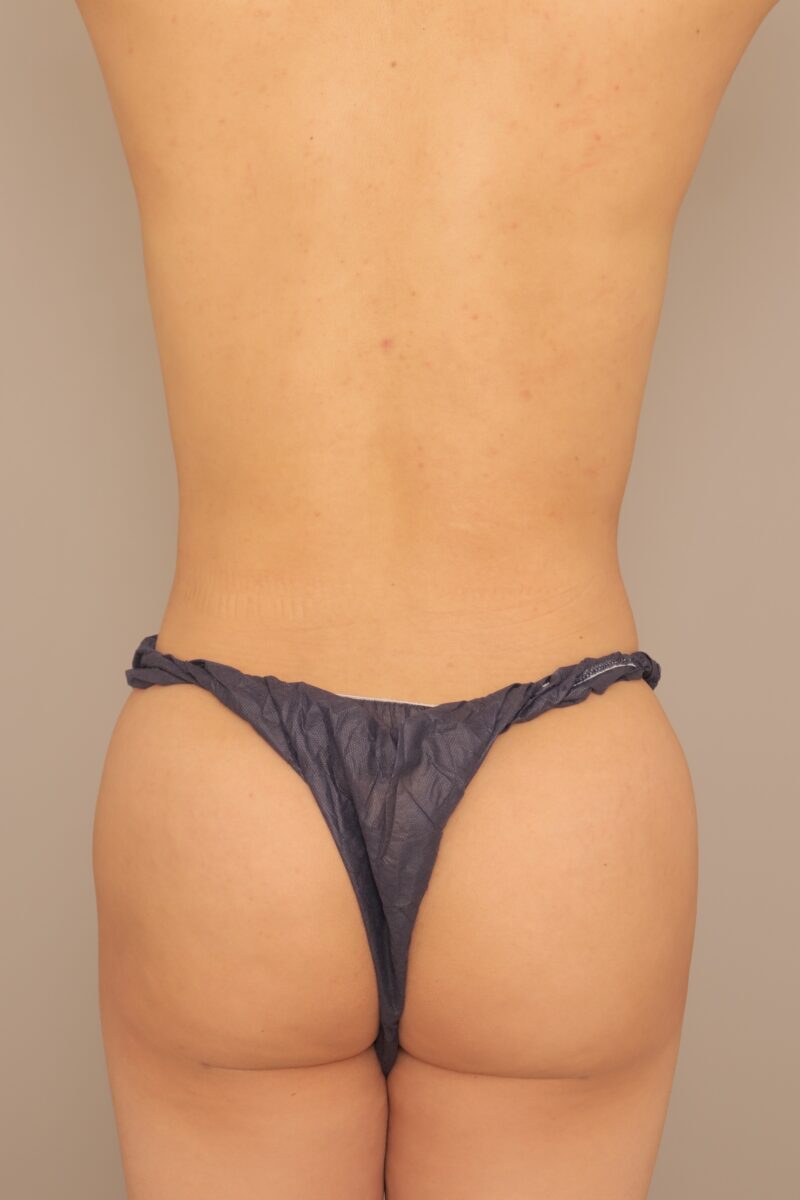 男性のブラジリアンバットリフトのモニター様8ヶ月後