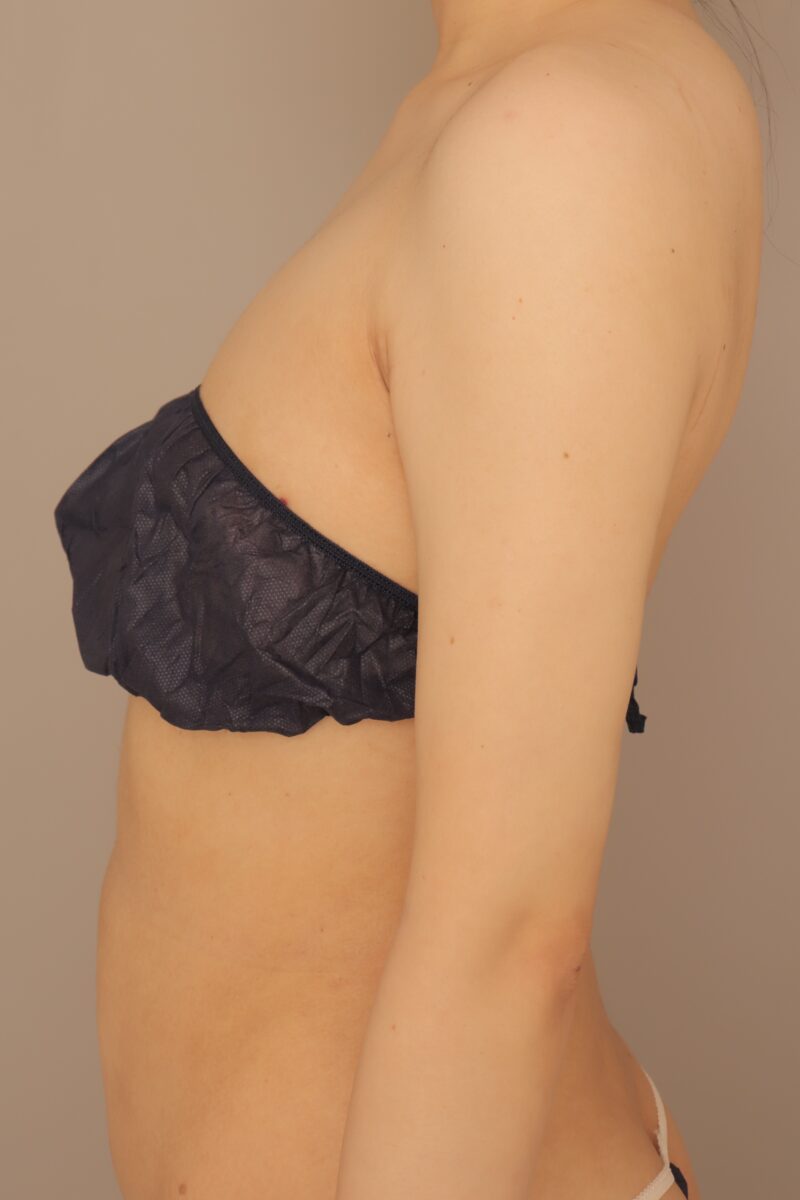 ダイエットの最後のひと押しに！30代モニター様二の腕、肩、脇肉の脂肪吸引3ヶ月後♡