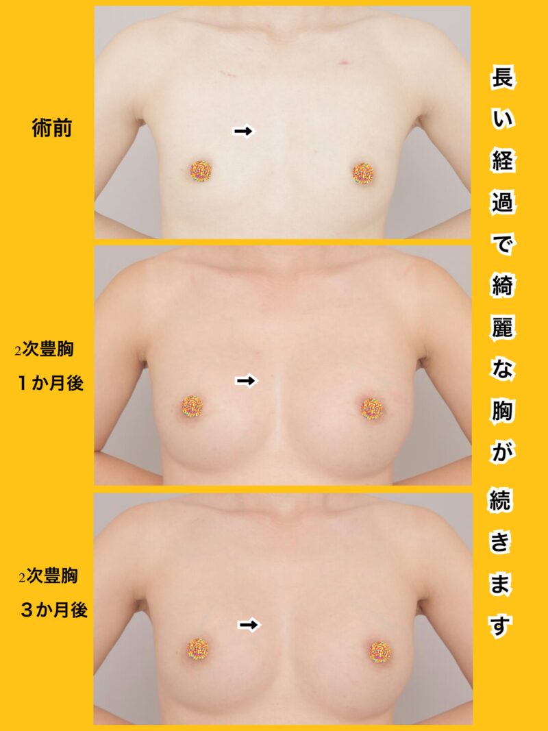 この美しさ！脂肪豊胸は〝形の綺麗さ〟で選ぶ時代です。お任せ下さい。～37歳154cm50kg脂肪豊胸（CRFバスト）2次豊胸後1ヶ月３か月～