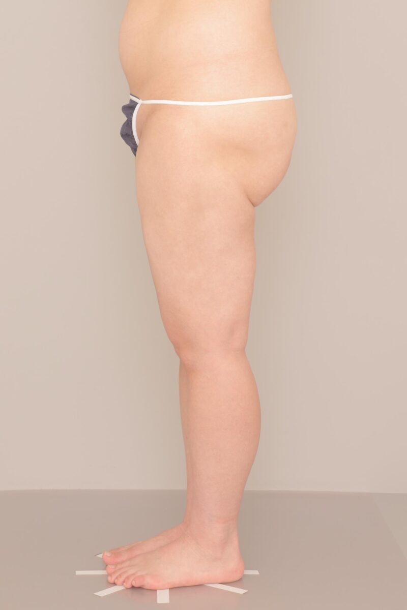【4500cc大量吸引！】“ずっと履けなかったパンツ”が似合う脚に。