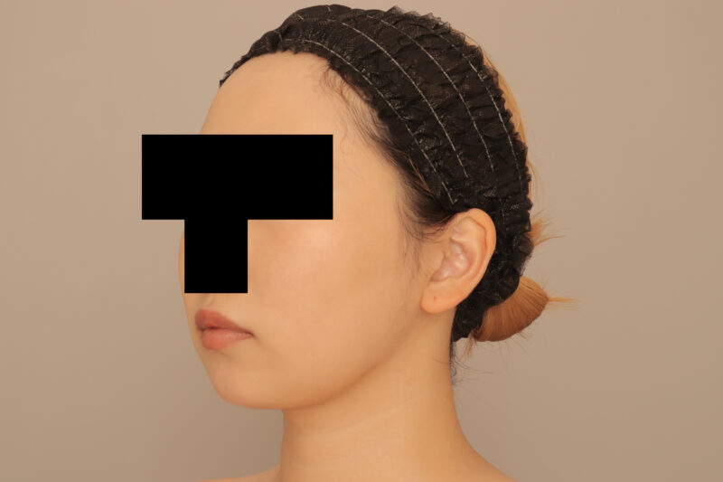 頬顎脂肪吸引でまっすます美人さんに♡30歳モニター様3ヶ月後