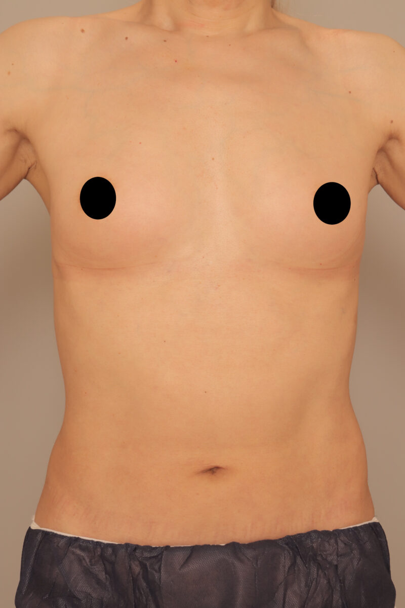 50代ホルモン治療なしの男性豊胸モニター様半年後♡