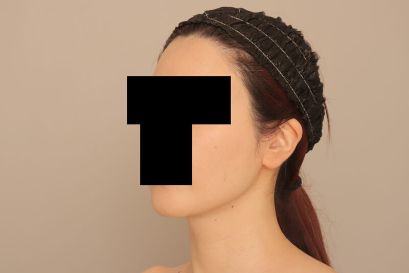 頬顎脂肪吸引であか抜け♡30代モニター様まっすます美人さんに♪