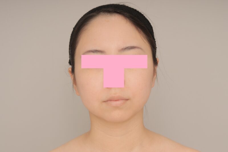 頬顎下脂肪吸引で自分を好きに♪　モニター様の6か月経過をご紹介♪　26歳 152cm 46kg