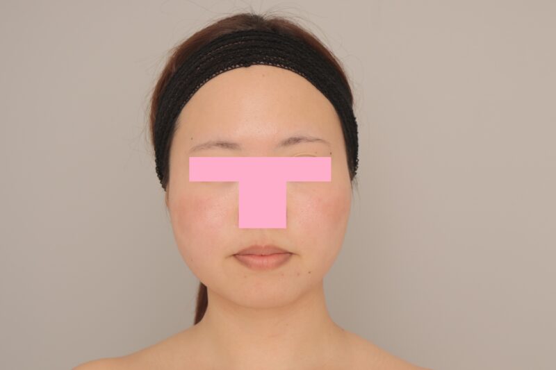 ベイザー脂肪吸引（6か月経過：30）の術前写真