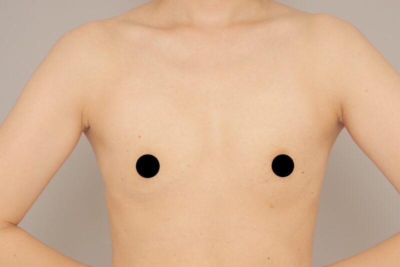 ベイザー脂肪吸引（3か月経過：35）の術前写真