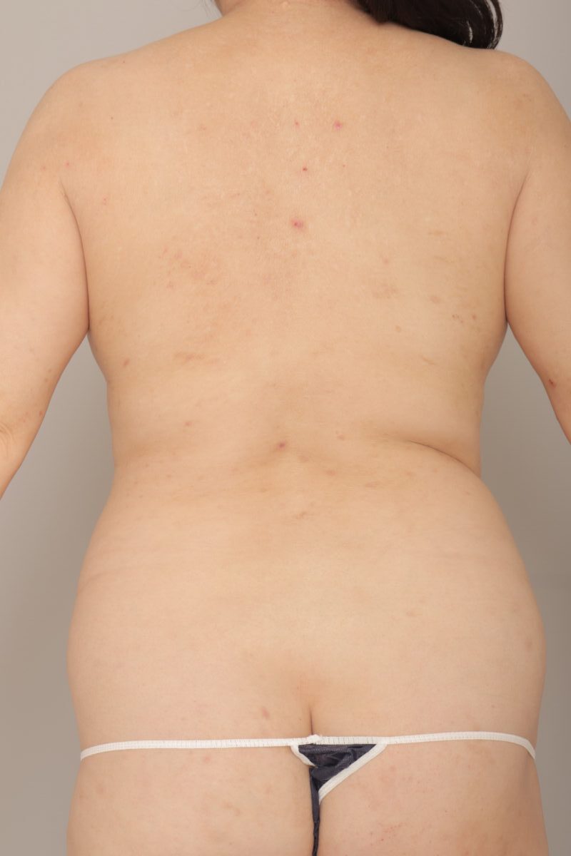 ベイザー脂肪吸引（6か月経過：44）の術前写真