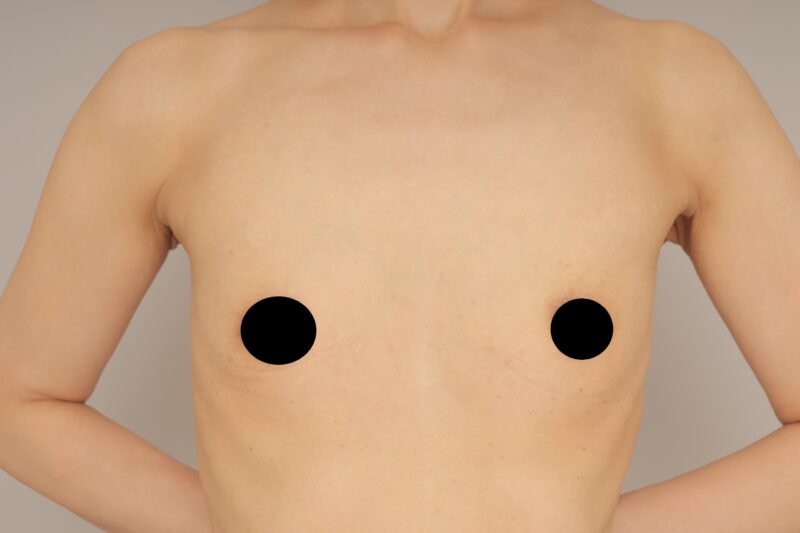 ベイザー脂肪吸引（3か月経過：38）の術前写真